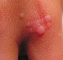 warts on the hand