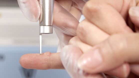 One of the methods for removing warts is the use of a laser