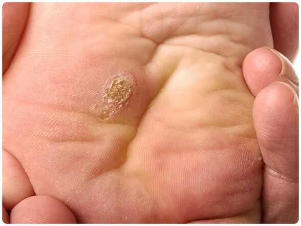 Painful warts on feet with deep roots
