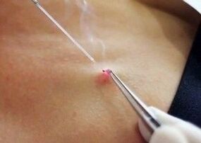 Laser