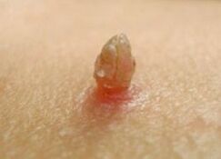 The sharp papilloma