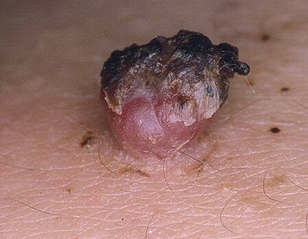 the blackened papilloma