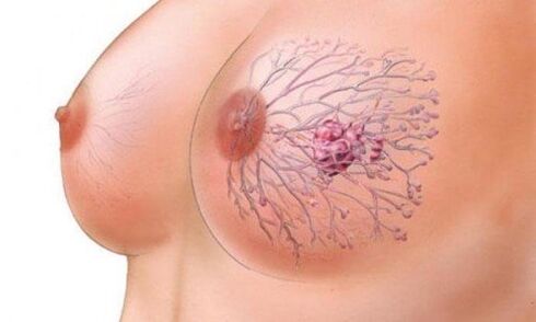 the chest papilloma