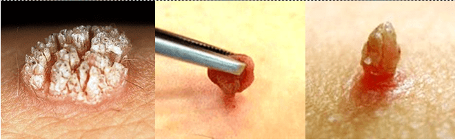 warts