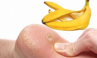Peel the banana for the treatment of a plantar Lyon