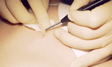 Surgical removal of plantar wart