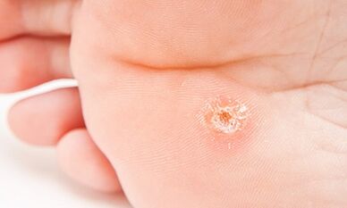 Why are planar warts appear
