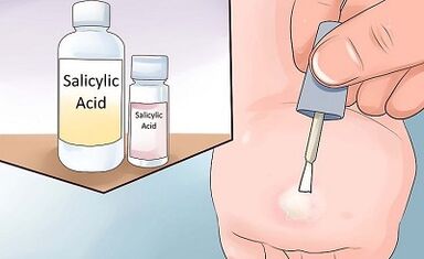 How to get rid of the popular ways of papillomas