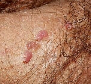 Papilloma on the penis