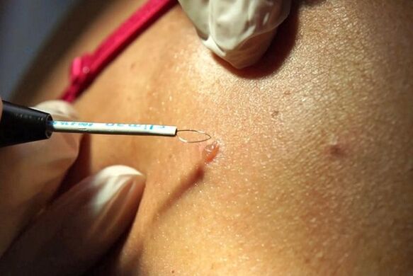 Removal of papillomas using the method of radio waves
