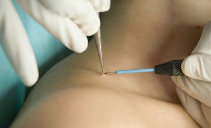 the use of radio wave therapy