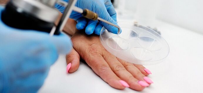 warts on the human body