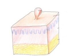 How to get rid of papilloma on the body