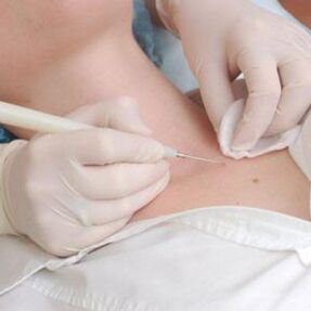 Treatment of papillomas in men