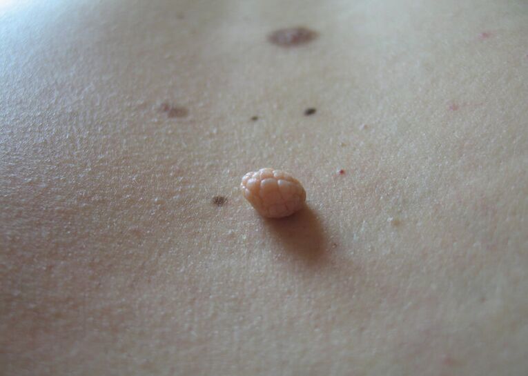 papilloma in the human body