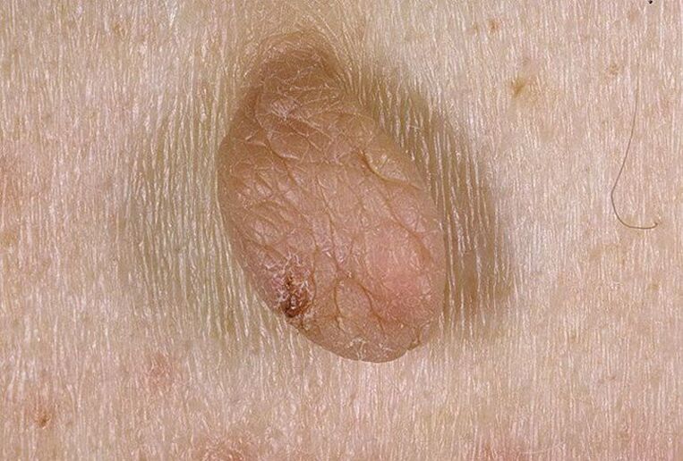 what warts and papillomas look like