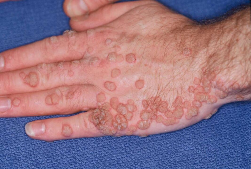 many papillomas on the hands