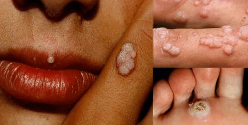 papilloma all over the body