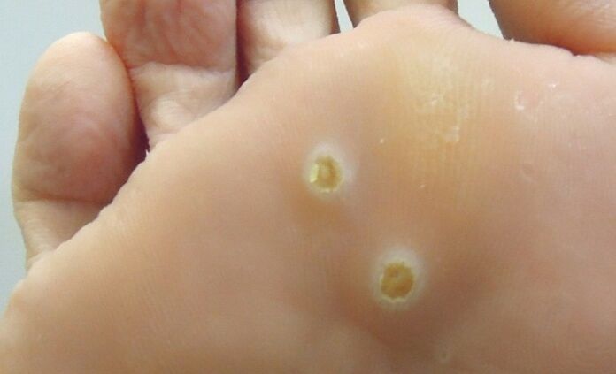 plantar papilloma on the foot