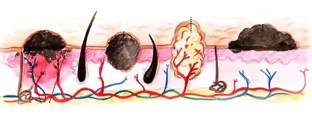 Types of papillomas in the human body