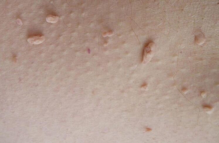 filamentous papilloma on the skin