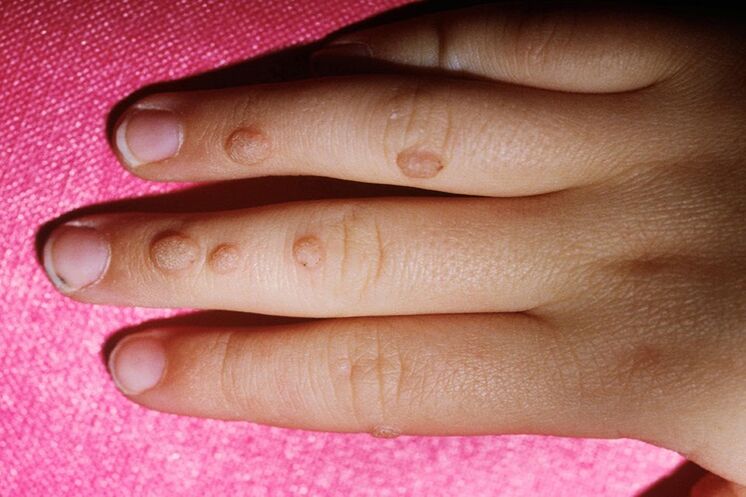 vulgar warts on fingers