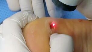 Laser foot wax removal